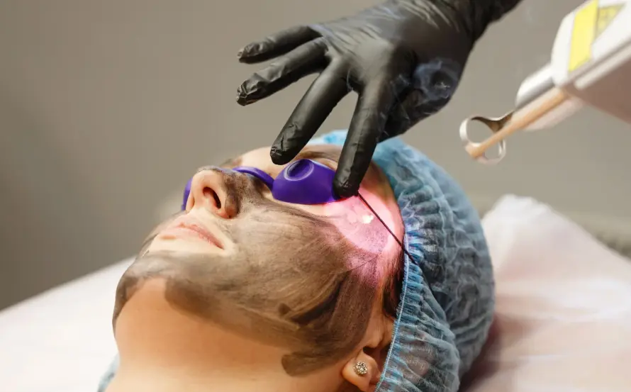 Everything About Carbon Laser Peel Hollywood Peel in Marathahalli