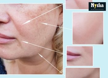 Top Benefits of Pigmentation Treatment in MSR Layout You Should Know