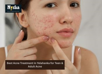 Best Acne Treatment in Yelahanka for Teen  Adult Acne