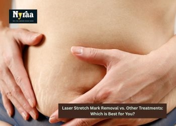 Laser Stretch Mark Removal vs Other Treatments Which is Best for You