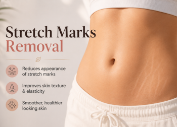 Stretch Marks Removal Causes Treatments  Best Solutions for Smooth Skin
