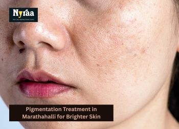 Pigmentation Treatment in Marathahalli for Brighter Skin