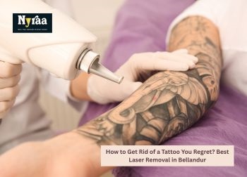 How to Get Rid of a Tattoo You Regret Best Laser Removal in Bellandur