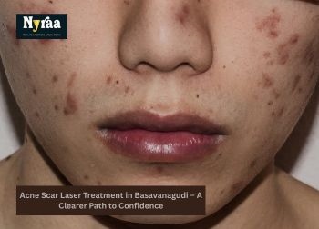 Acne Scar Laser Treatment in Basavanagudi