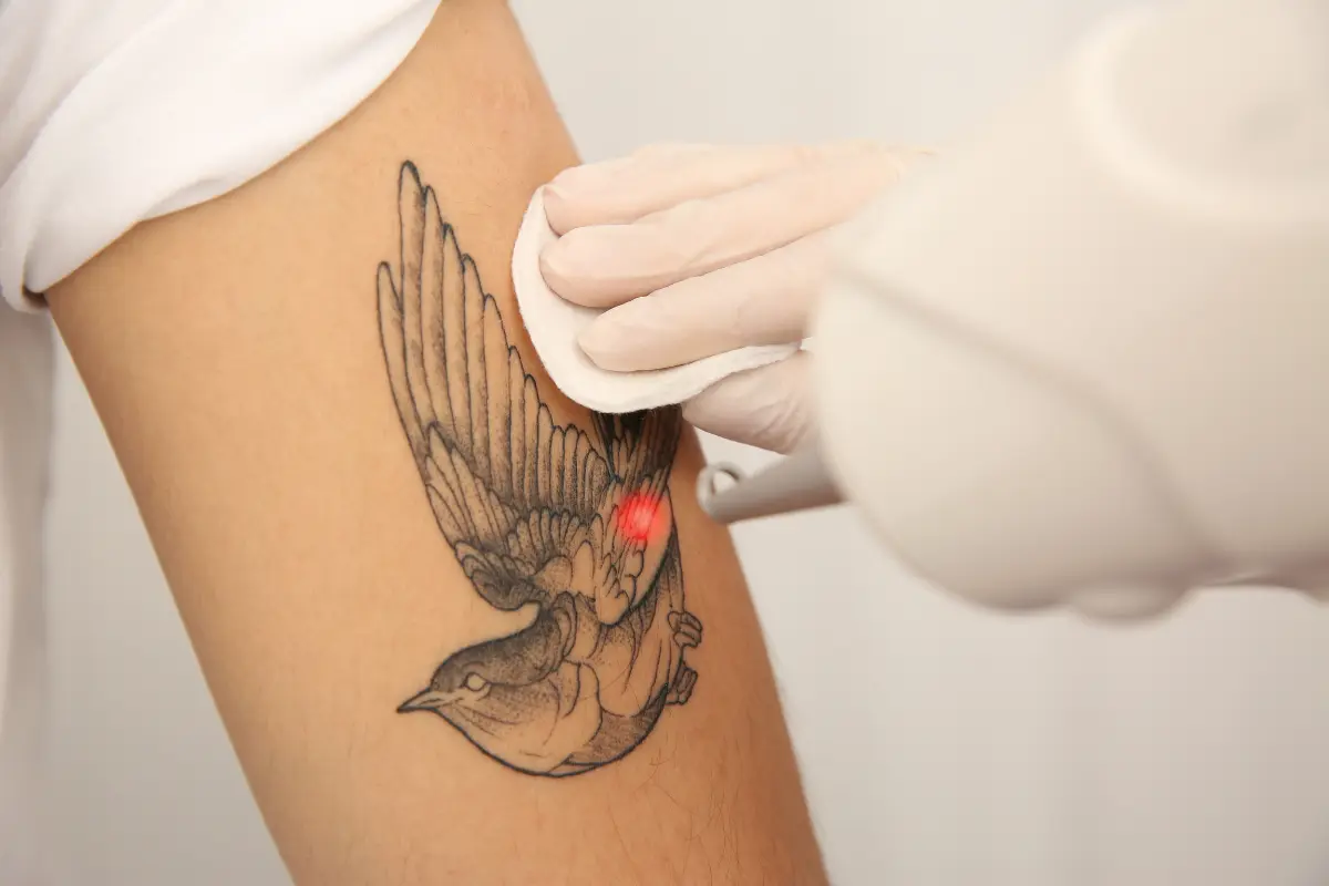 Tattoo Removal Blog - Laser Skin Care