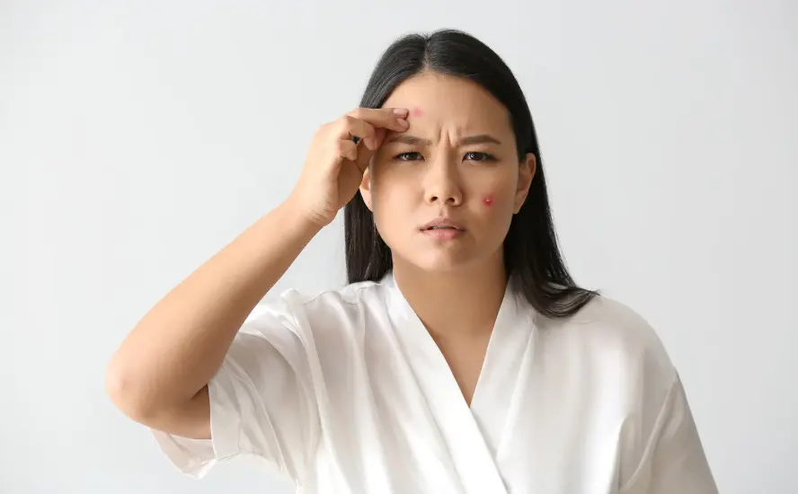 When Should You Consider Advanced Acne Treatments Like Peels or Lasers