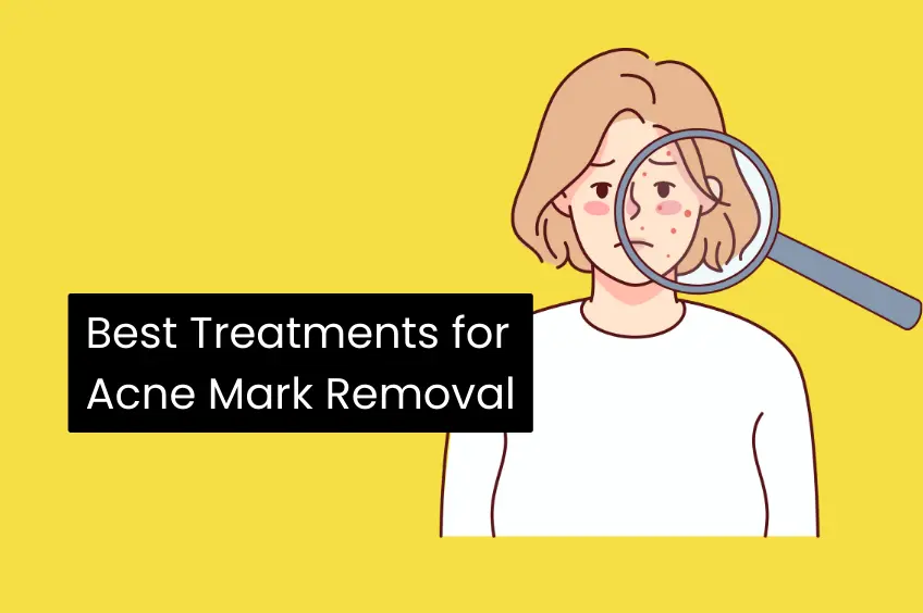 Best Treatments for Acne Mark Removal