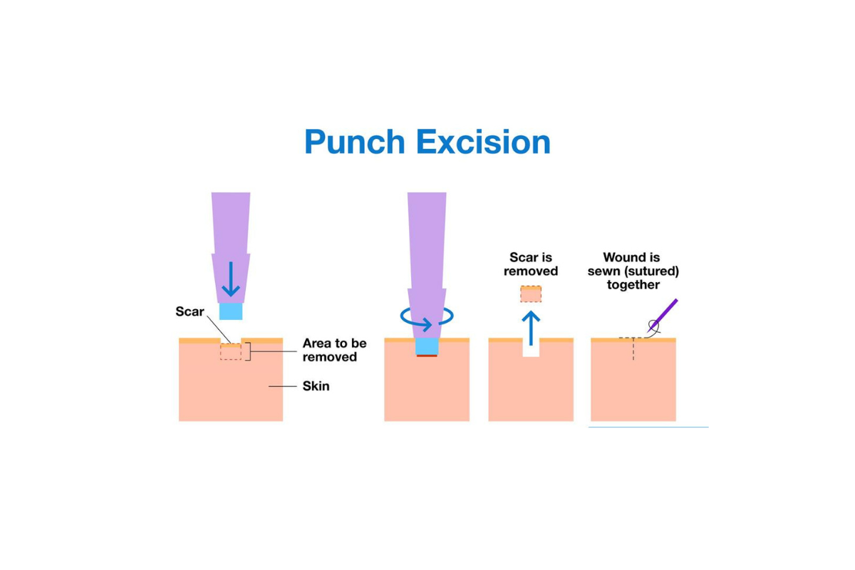 Punch Excision Acne Scar Treatment in Sanjay Nagar | Nyraa